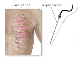 Needle biopsy procedure