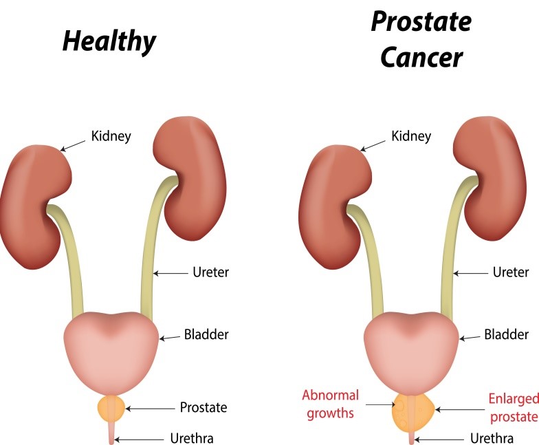 Prostate Cancer | VLMMHI