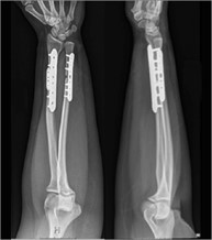 Radius and ulnar shaft fractures