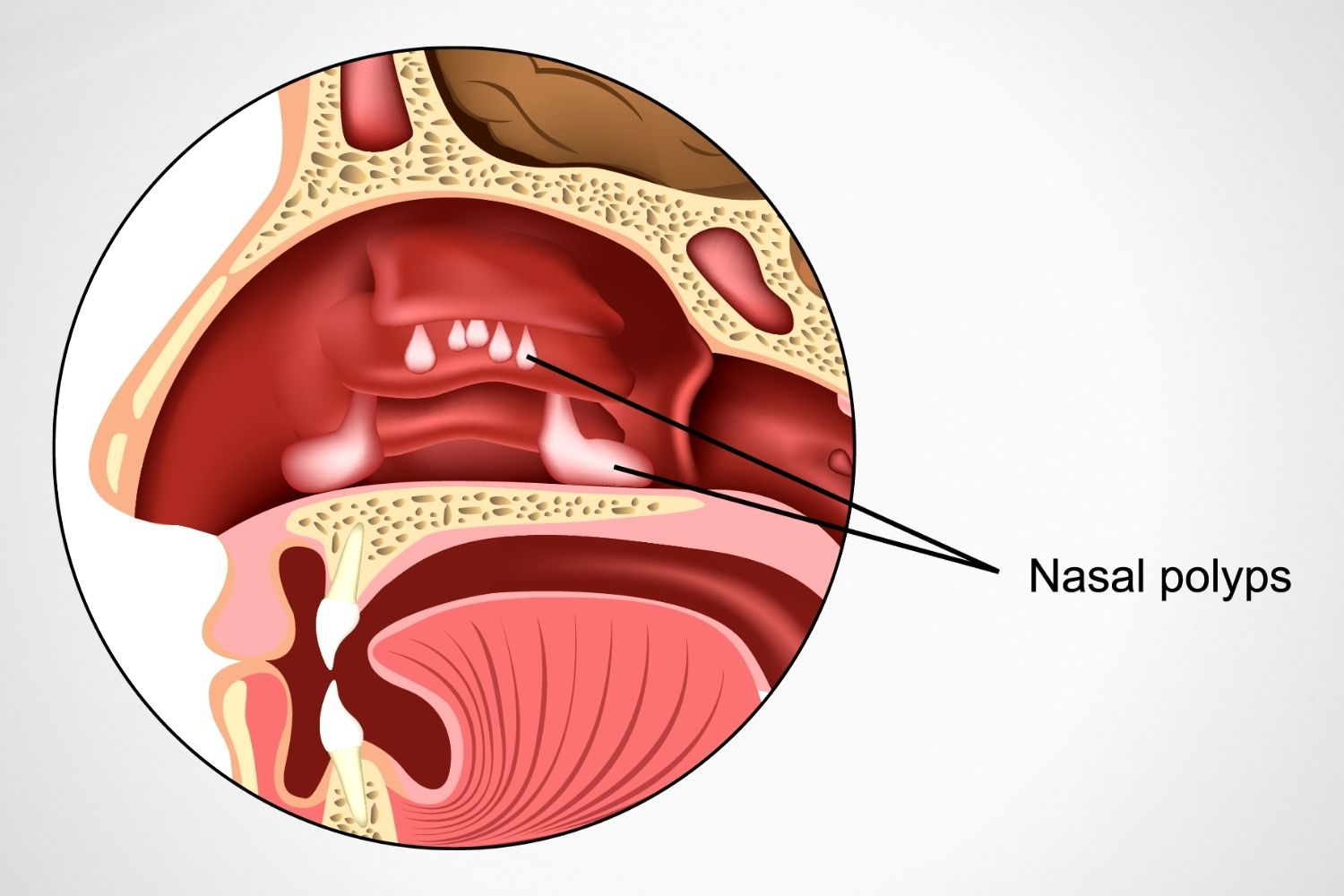 Nasal Polyps V L Makabali Memorial Hospital Inc nasal-polyps-v-l-makabali-memorial-hospital-inc