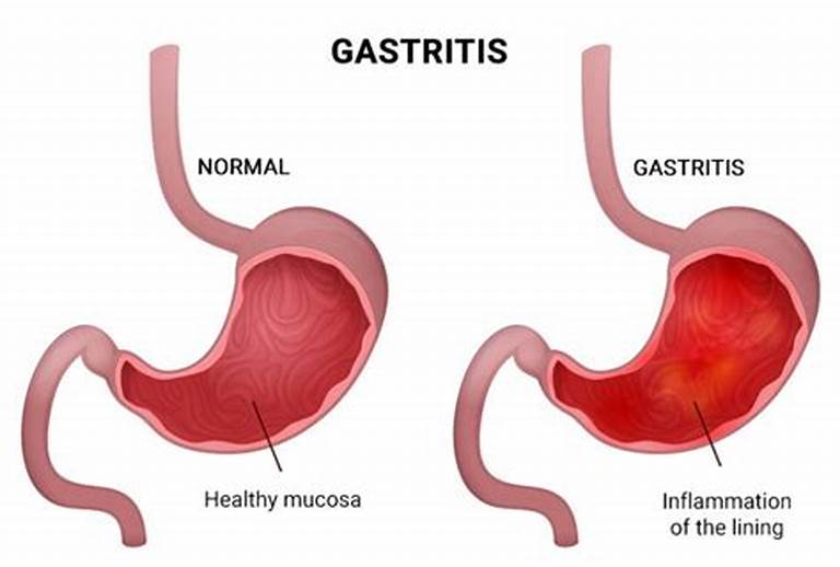 Gastritis | V.L. Makabali Memorial Hospital, Inc.