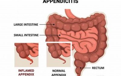 What is Appendicitis?