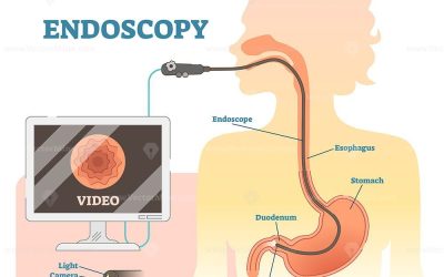 What Is the Difference Between Endoscopy and Esophagoscopy?