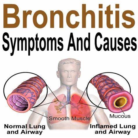 The Best Medicine and Treatment for Bronchitis? | V.L. Makabali ...