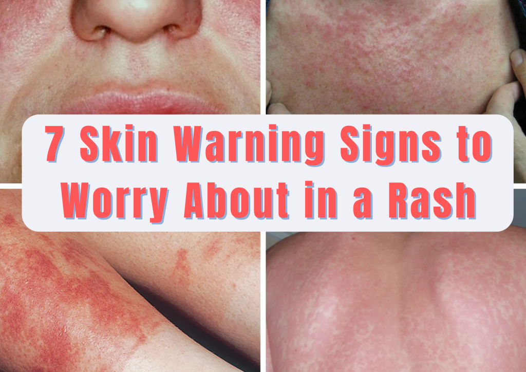 7-skin-warning-signs-to-worry-about-in-a-rash-v-l-makabali-memorial