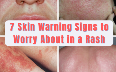 7 Skin Warning Signs to Worry About in a Rash