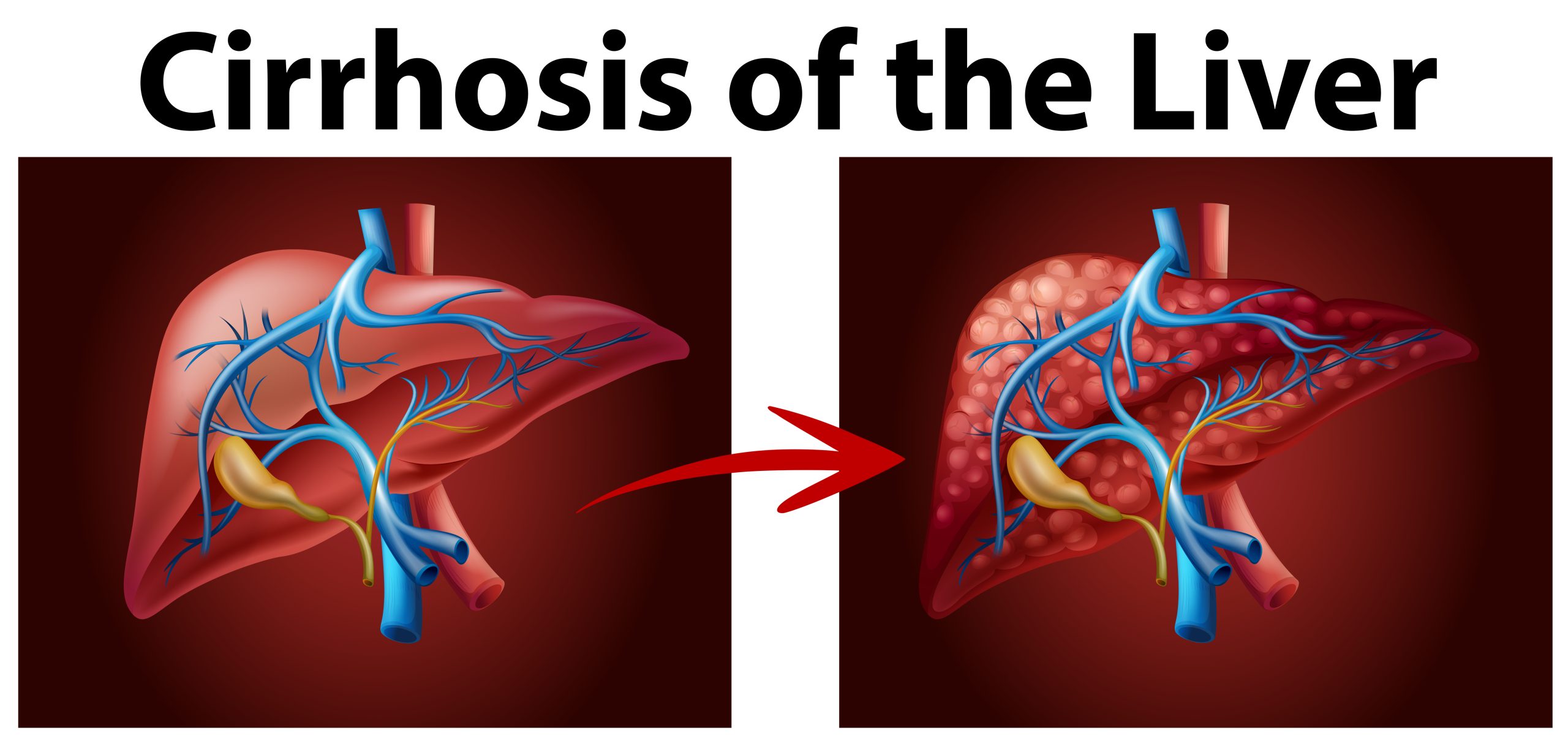 Liver Cirrhosis | V.L. Makabali Memorial Hospital, Inc.