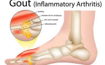 Gout (Inflammatory arthritis)