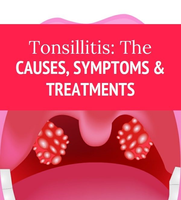 Tonsillitis, cause, symptoms and treatment? | V.L. Makabali Memorial ...