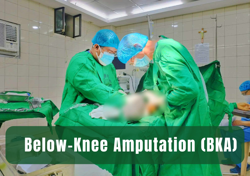 Below-Knee Amputation (BKA) | V.L. Makabali Memorial Hospital, Inc.