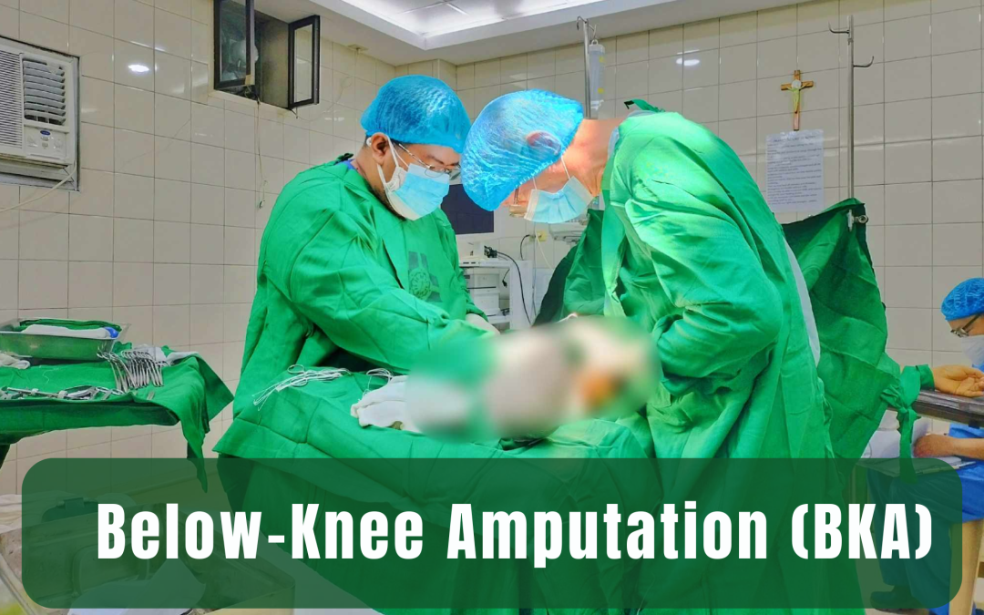 Below-Knee Amputation (BKA)