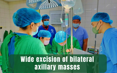 A Wide excision of bilateral axillary masses